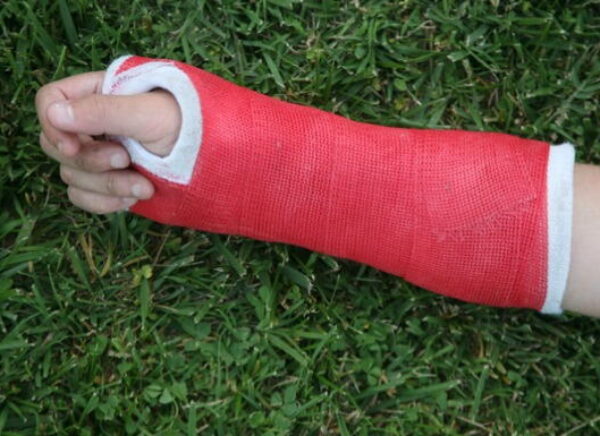 Red wrist arm and hand cast main process sc720x385 t1648045986