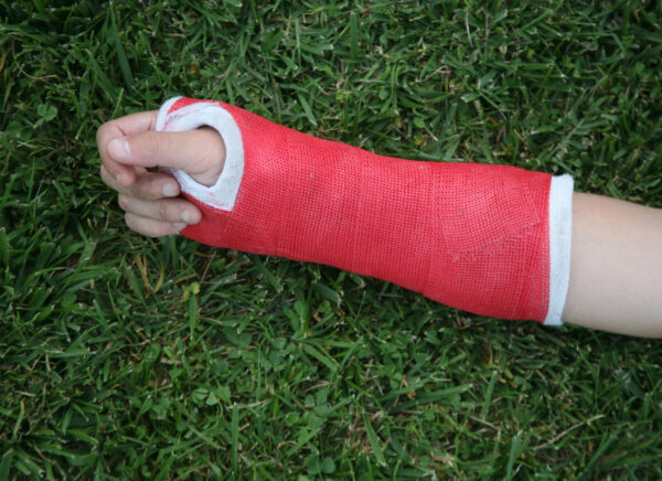 Red wrist arm and hand cast scaled